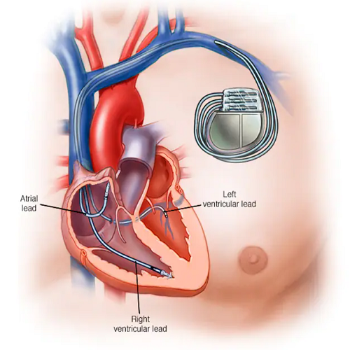 Cardilogist gorakhpur pacemaker