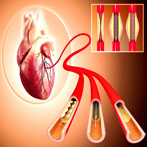 angioplasty gorakhpur dr dinesh singh